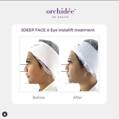 3Deep Eye Treatment